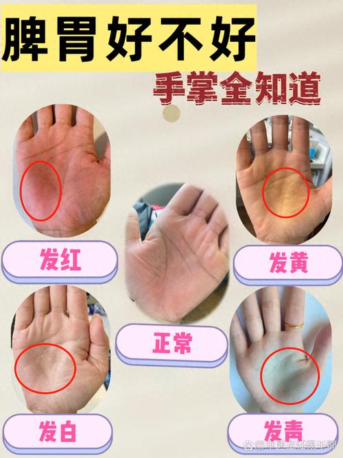 为什么手掌发红？四种疾病需及时就医检查！
