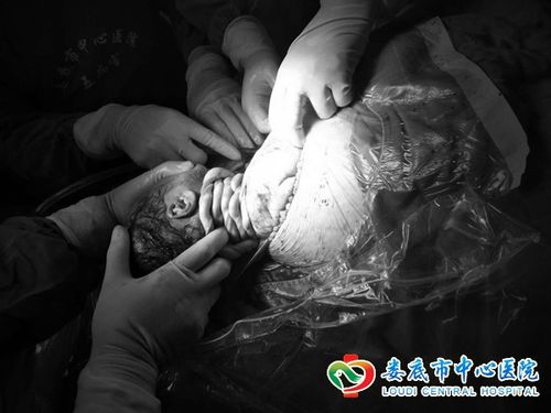 警报解除！王红医生成功救治脐带绕颈婴儿