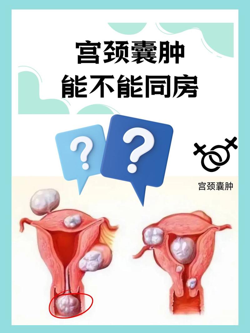 宫颈红警囊肿的预防和治疗，你需要知道的都在这里