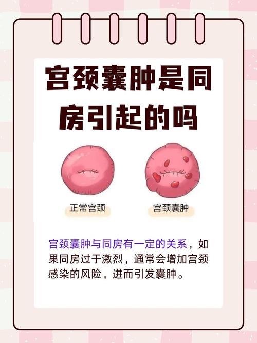 宫颈红警囊肿的预防和治疗，你需要知道的都在这里